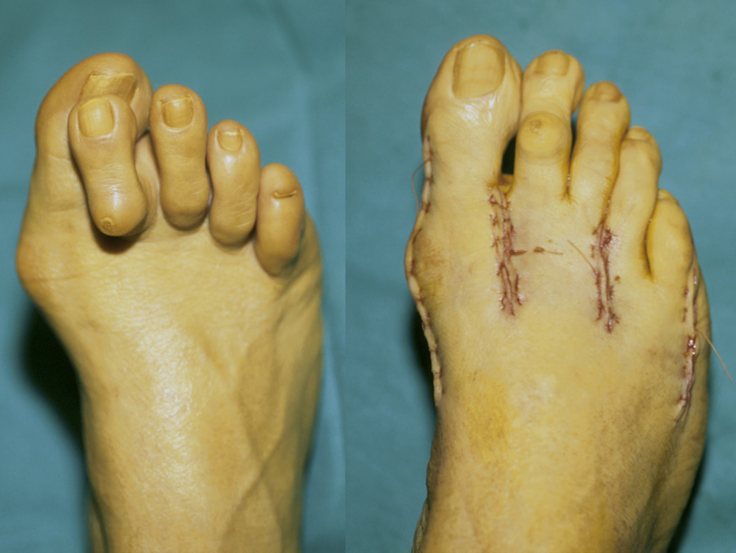 Help For Contracted Toes Thresa Bauswell